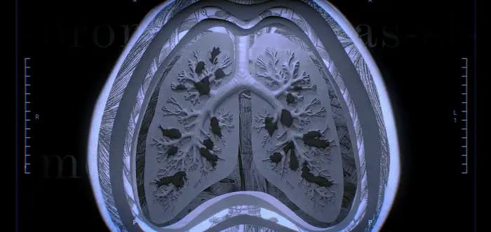 CT scan illustration of a lung with bronchiectasis (BE)