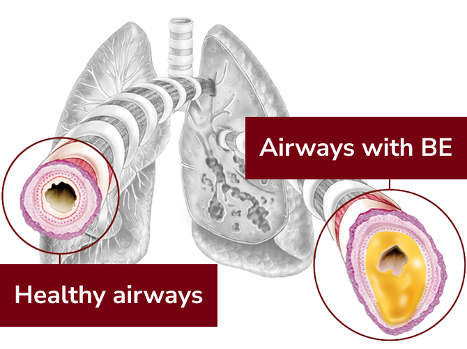 cross section of healthy airways in lung and airways with bronchiectasis (BE)