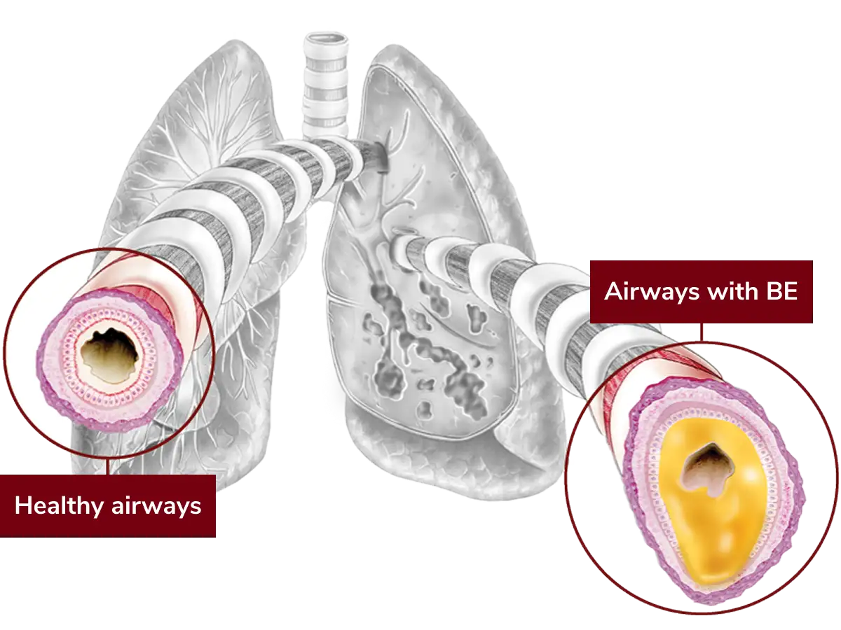 cross section of healthy airways in lung and airways with bronchiectasis (BE)