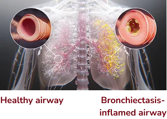 Cross section of healthy airway and bronchiectasis inflamed airway