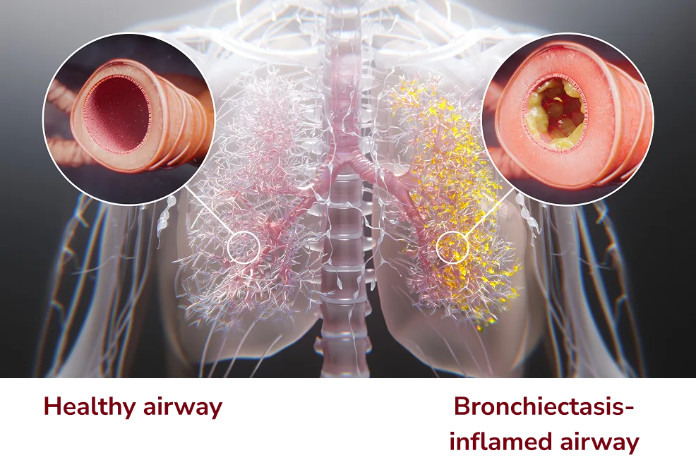 Cross section of healthy airway and bronchiectasis inflamed airway