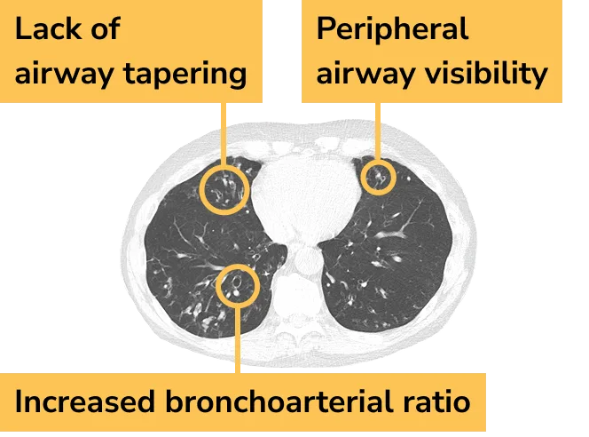 CT scan of lungs showing widened airways caused by bronchiectasis (BE)