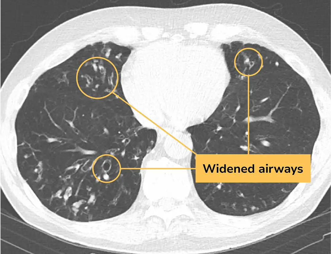 CT scan image of a lung with bronchiectasis (BE)